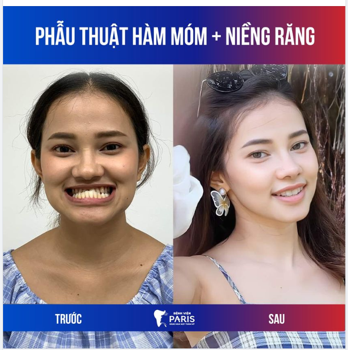 THÀNH QUẢ CỦA KH SAU KHI PHẪU THUẬT HÀM MÓM  NIỀNG RĂNG