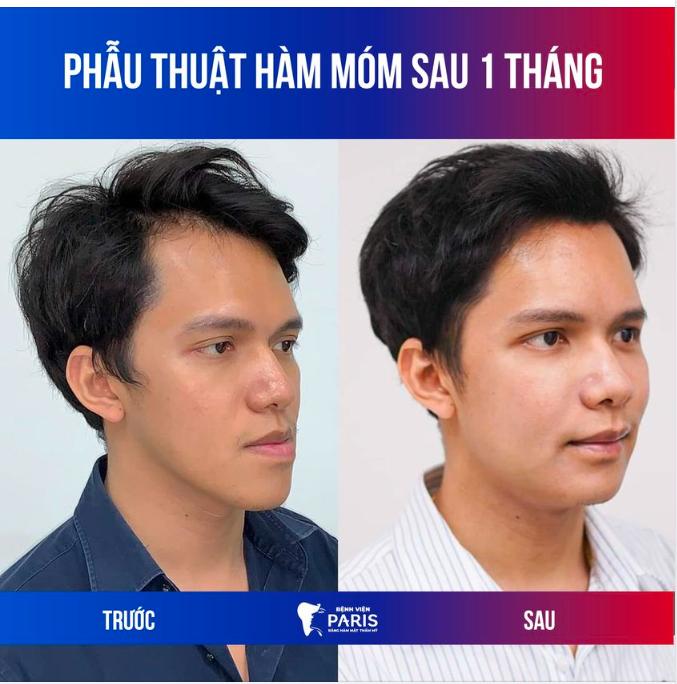 THÀNH QUẢ CỦA KHÁCH HÀNG SAU 1 THÁNG PT HÀM MÓM