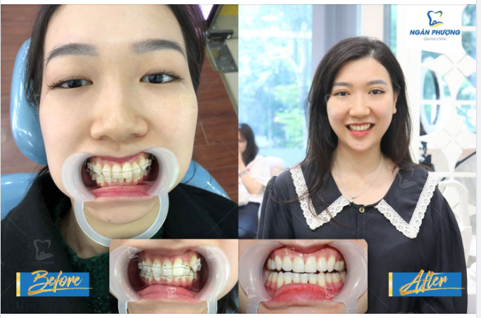 Tháo niềng răng đẹp là vui dân niềng