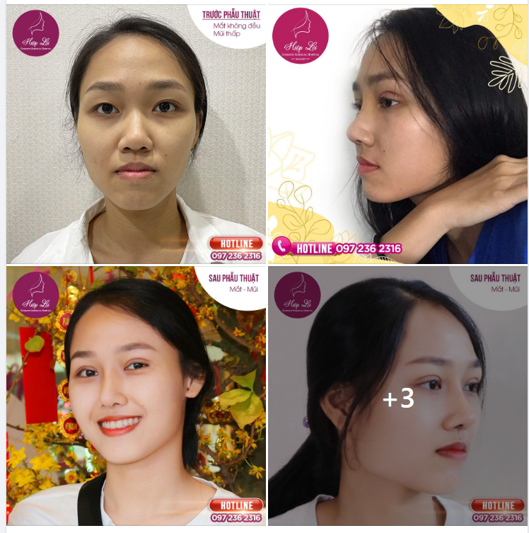 THÊM 1 COMBO MẮT ĐẸP - MŨI XINH, TỰ TIN KHOE SẮC