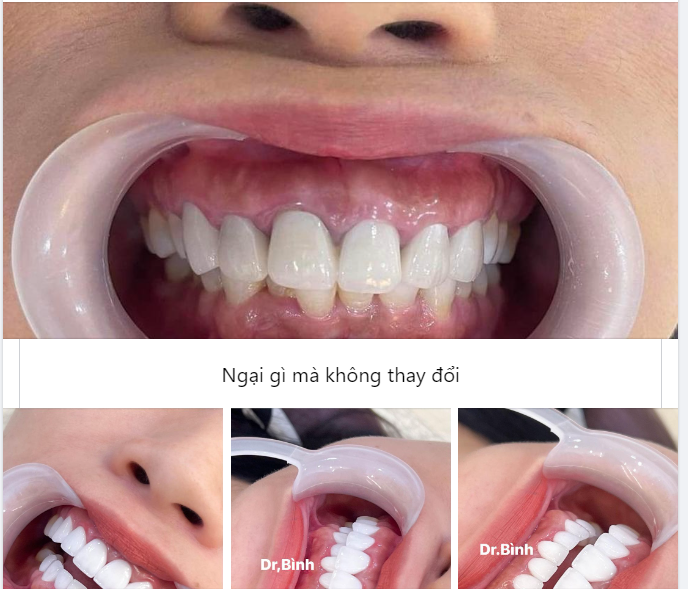 THÊM MỘT CA GIẢI CỨU THÀNH CÔNG RĂNG SỨ HỎNG TẠI DELIA