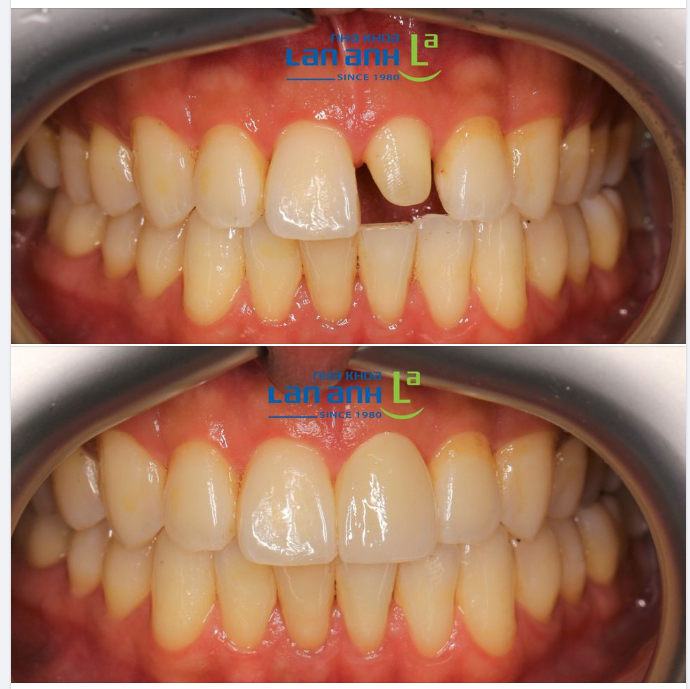  Thêm một ca phục hình răng sứ như thật của bác sĩ Liên, chi nhánh Sala, quận 2!
