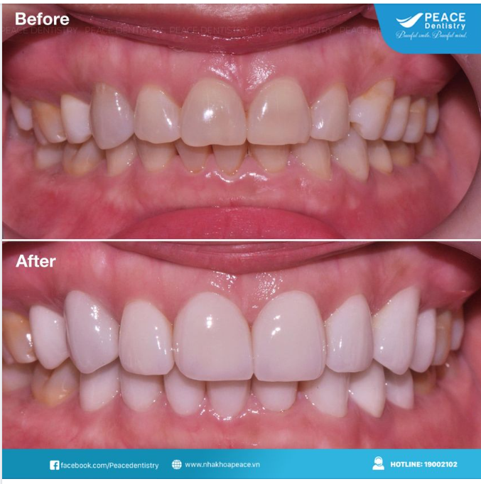 Thiết kế lại nụ cười với mặt dán sứ Veneer