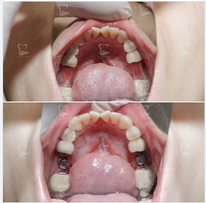 Thời điểm vàng để tiến hành trồng răng đối với răng mất