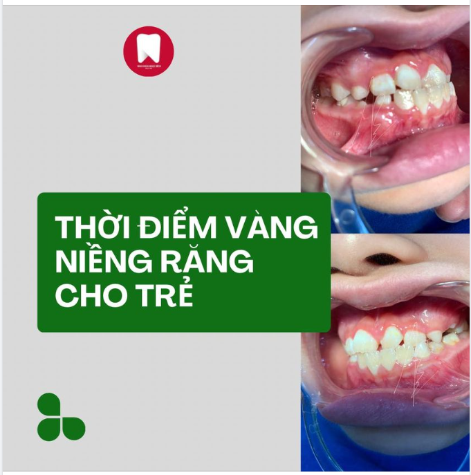 THỜI ĐIỂM “VÀNG” NIỀNG RĂNG CHO TRẺ