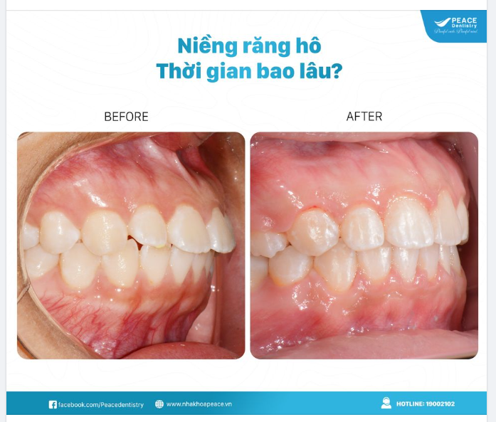 THỜI GIAN NIỀNG RĂNG HÔ MẤT BAO LÂU?