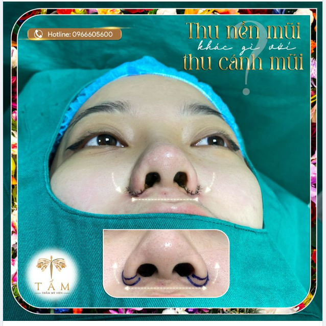 Thu cánh mũi là dịch vụ quen thuộc đối với nhiều người còn thu nền mũi là khái niệm khá mới.