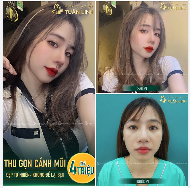 THU GỌN CÁNH MŨI - GIÁ CHỈ 4TR