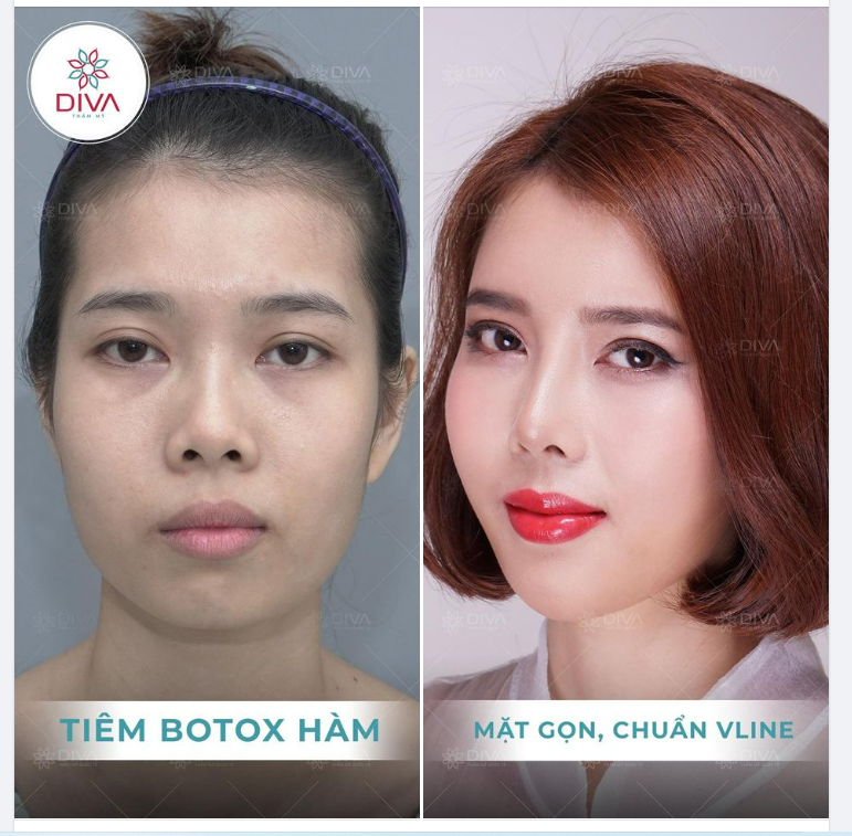 TIÊM BOTOX GỌN HÀM – SỞ HỮU MẶT VLINE KHÔNG PHẪU THUẬT
