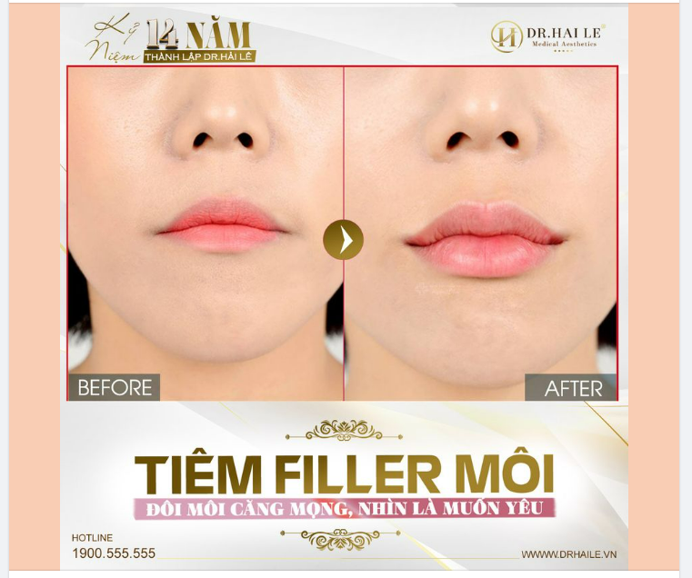 Tiêm filler tạo hình môi trái tim - Bí quyết cho đôi môi luôn căng mọng, tươi tắn