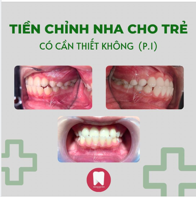 TIỀN CHỈNH NHA CHO TRẺ CÓ CẦN THIẾT KHÔNG