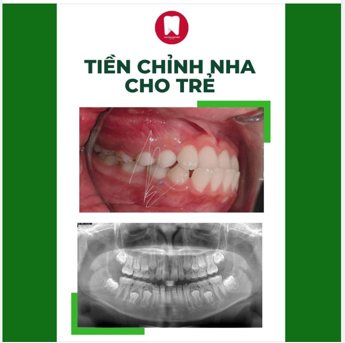 TIỀN CHỈNH NHA CHO TRẺ LÀ GÌ