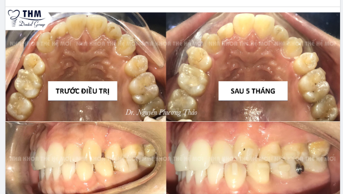 TIẾN ĐỘ CHỈNH NHA BẰNG KHAY TRONG SUỐT LEGACY