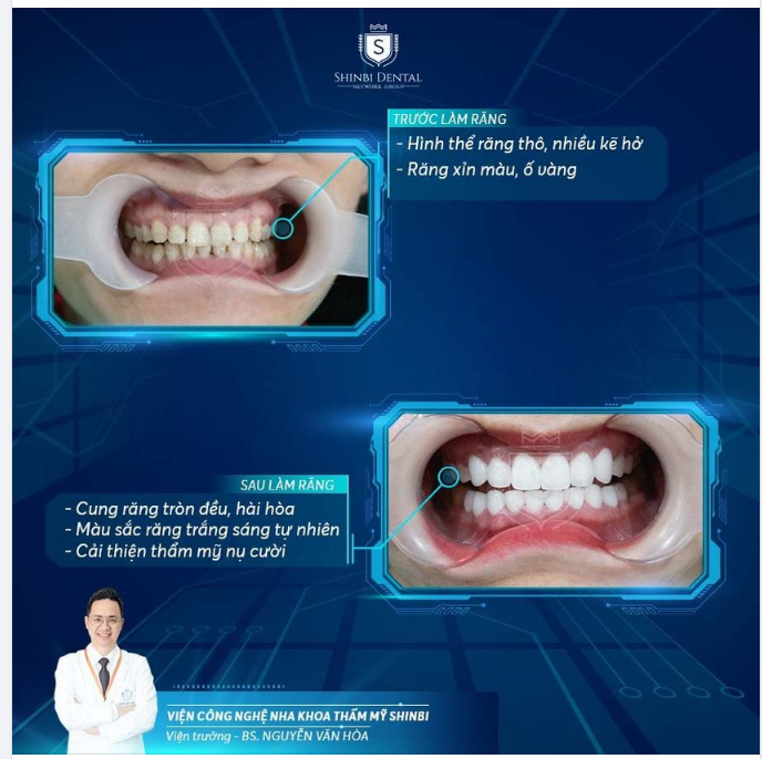 TIẾN TRÌNH CA BỌC RĂNG SỨ VENEER