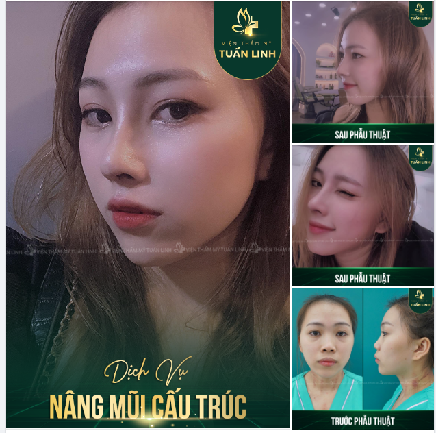 Tiếng lành đồn xa đến Tuấn Linh là sẽ có mũi xinh cực phẩm 