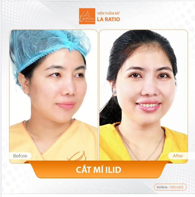 TÌNH TRẠNG MẮT CỦA BẠN LÀ GÌ