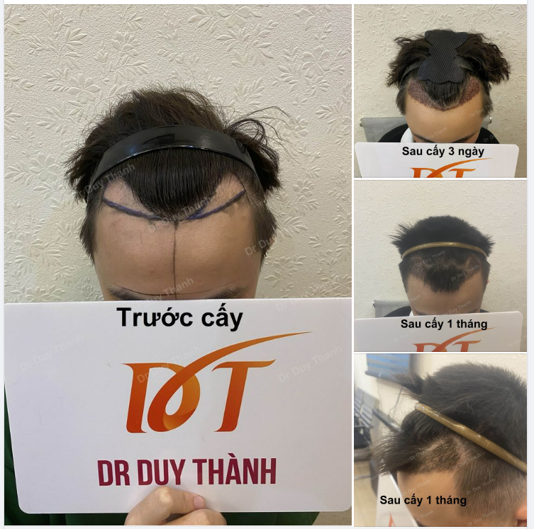 TÓC CẤY SAU 1 THÁNG CỦA KHÁCH HÀNG TRẺ TUỔI