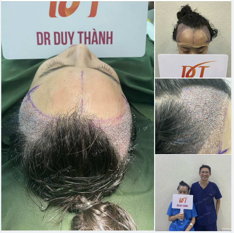 TRẢ KẾT QUẢ CA CẤY TÓC NỮ 1700 NANG NGÀY HÔM QUA