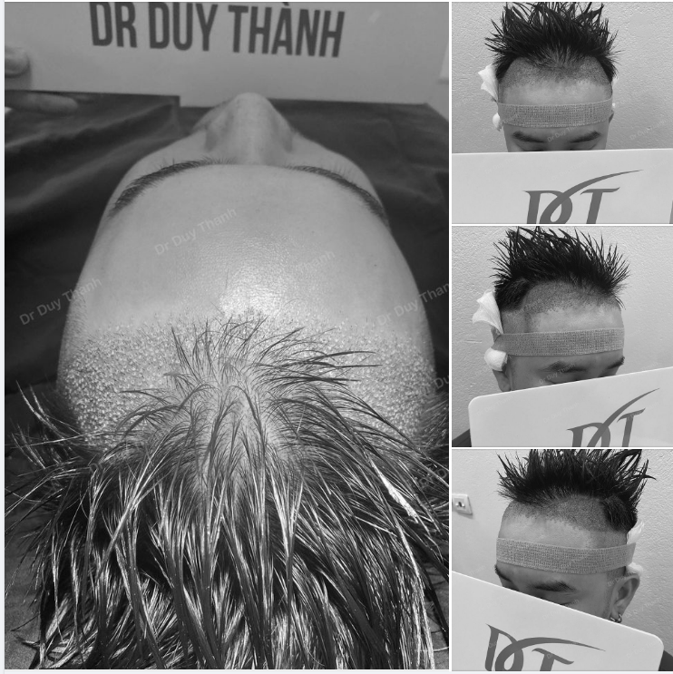 TRẢ KẾT QUẢ CA CẤY TÓC SÁNG NAY, CA CẤY CHỈNH SỬA TỪ HÀN QUỐC