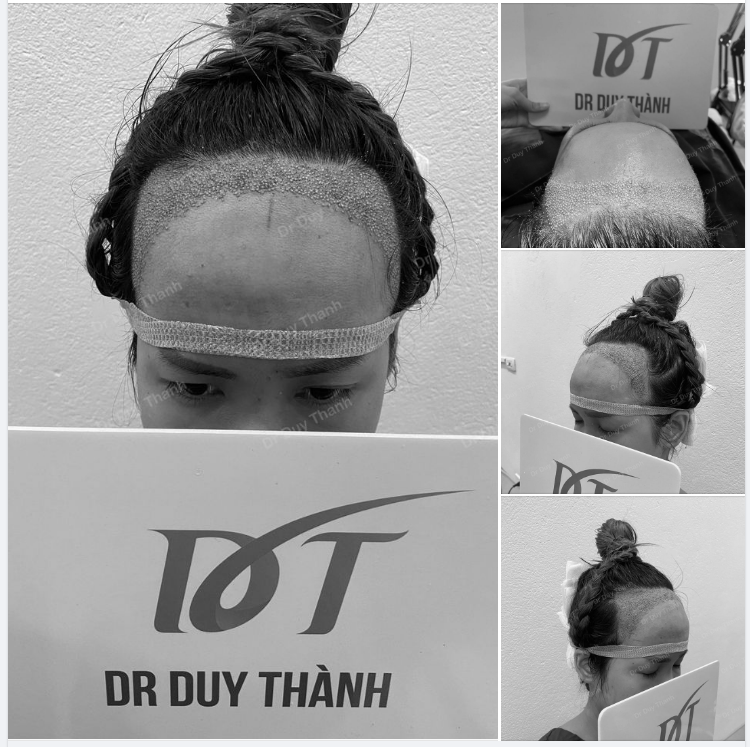TRẢ KẾT QUẢ CẤY 1200 NANG TÓC CHO KHÁCH NỮ TỪ NHẬT BẢN ( HÔM QUA).