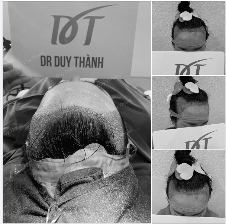 TRẢ KẾT QUẢ CẤY 1500 NANG TÓC CHO KHÁCH NỮ TỪ TP.HCM