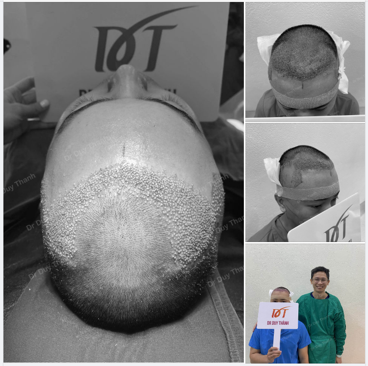 TRẢ KẾT QUẢ CẤY 1600 NANG TÓC CHO BOY TP.HCM 31 TUỔI