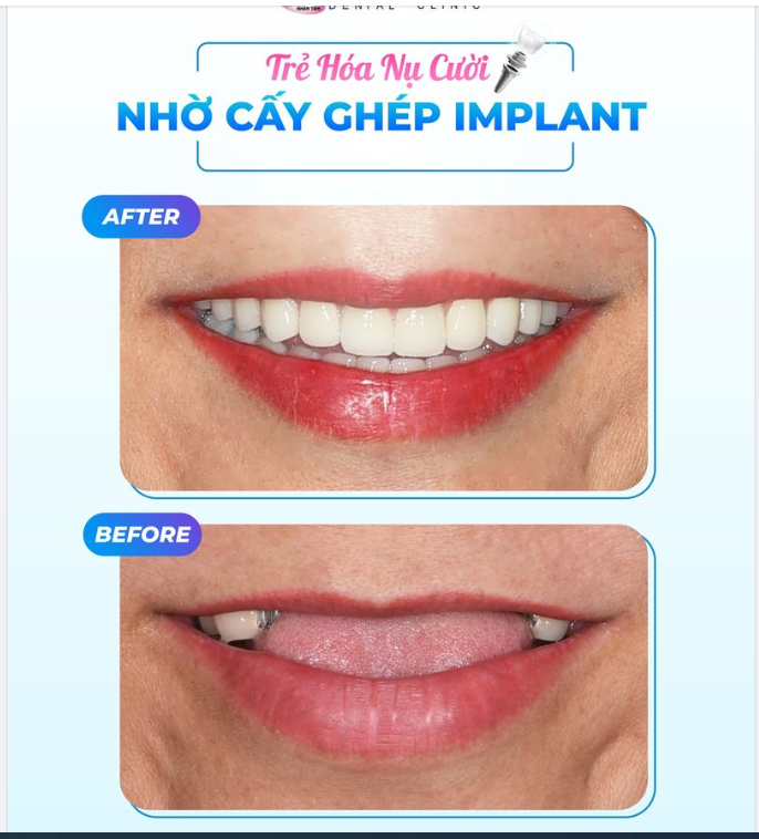 Trẻ Hóa Nụ Cười Nhờ Cấy Ghép Implant