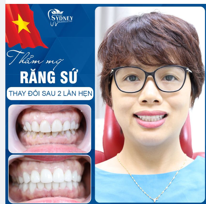 TRẺ HÓA NỤ CƯỜI SAU 2 LẦN HẸN VỚI PHƯƠNG PHÁP PHỤC HÌNH RĂNG SỨ THẨM MỸ