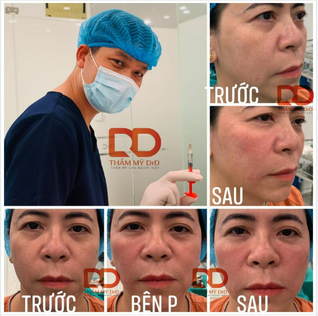 Trẻ hoá toàn bộ tầng mặt giữa bằng Filler. Case này cần bao nhiêu cc filler