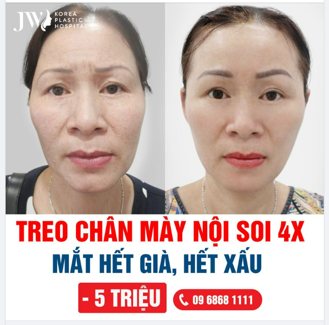 Các yếu tố cần xem xét trước khi quyết định nâng cung chân mày nội soi là gì?
