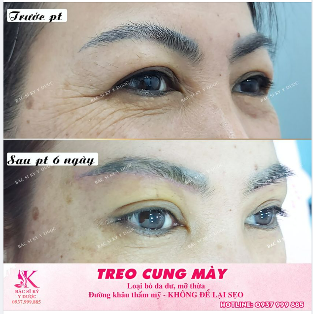 TREO CUNG MÀY CHỈ 6 TRIỆU CHÍNH TAY BÁC SĨ KỲ Y DƯỢC thực hiện