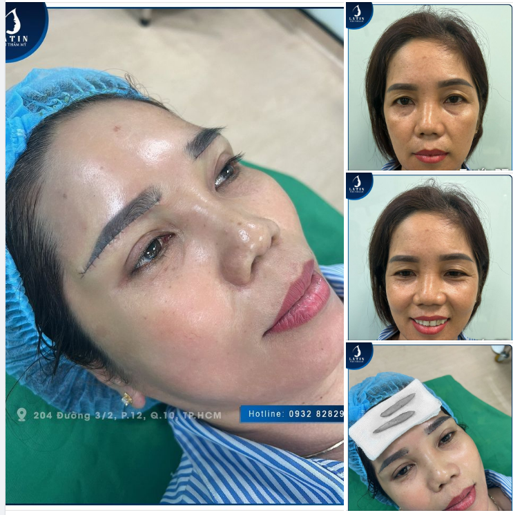 Treo cung mày đa tầng cho chị khách trung niên nhà Latin