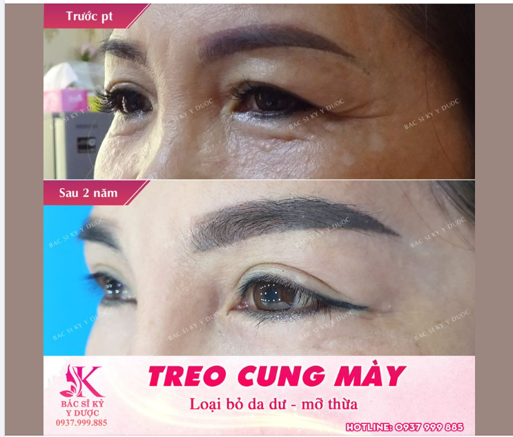 Treo cung mày hồi sinh cho đôi mắt