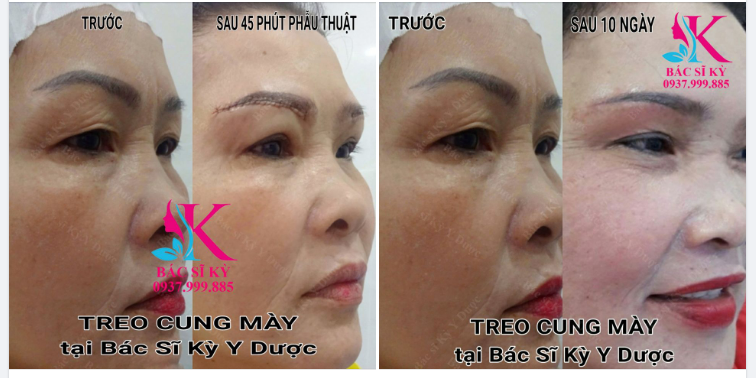 Treo cung mày tại Bác sĩ KỲ Y Dược cải thiện gì cho vùng mắt