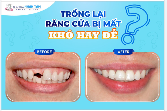 Trồng lại răng cửa bị mất – Khó hay dễ?