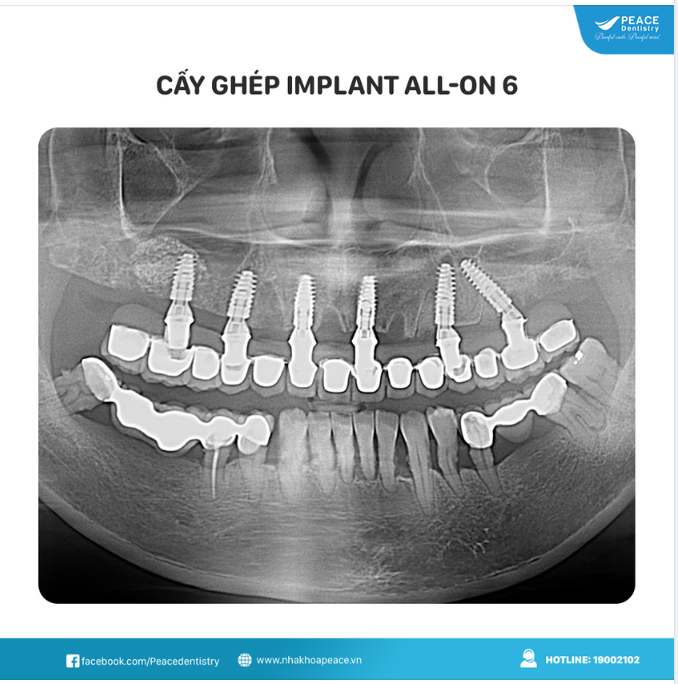 TRỒNG RĂNG IMPLANT GIẢI PHÁP TỐI ƯU CHO NGƯỜI CAO TUỔI MẤT RĂNG