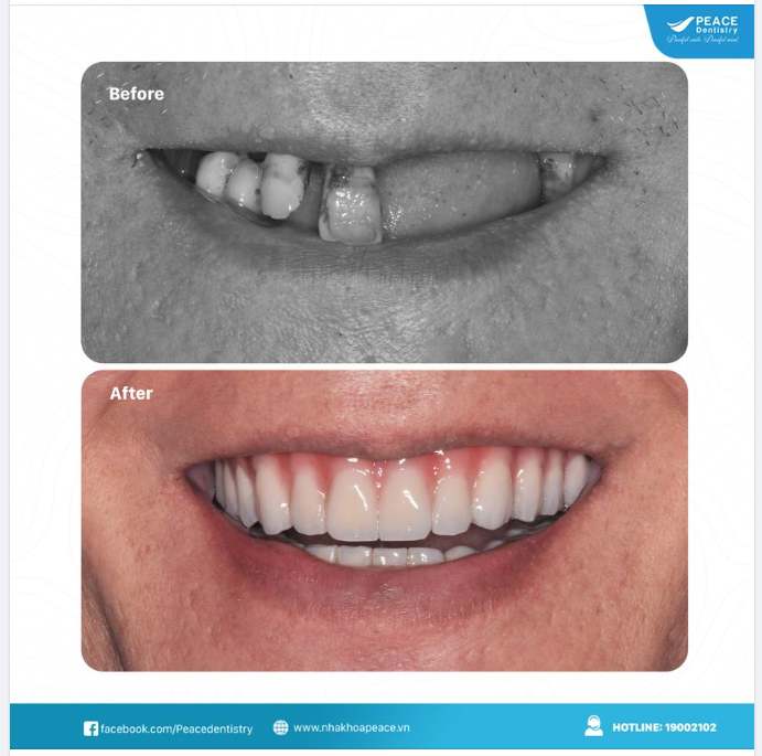 TRỒNG RĂNG IMPLANT MANG LẠI GIÁ TRỊ LÝ TƯỞNG TƯƠNG ĐỒNG NHƯ RĂNG THẬT
