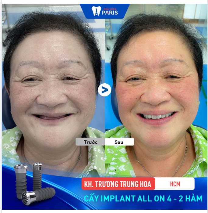 TRỒNG RĂNG IMPLANT TOÀN HÀM KỸ THUẬT SIÊU KHÓ.