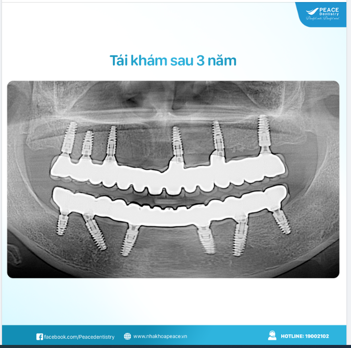 TRỒNG RĂNG IMPLANT VỚI ƯU ĐÃI ĐẶC BIỆT HẤP DẪN