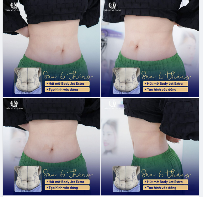 Update vóc dáng sau sinh với Hút mỡ siết eo BodyJet Extra