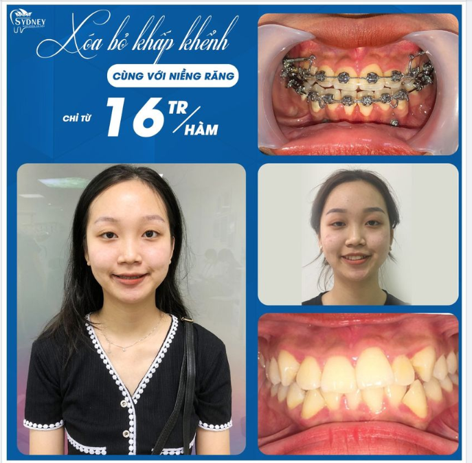 Vì sao nên niềng hàm răng khấp khểnh?