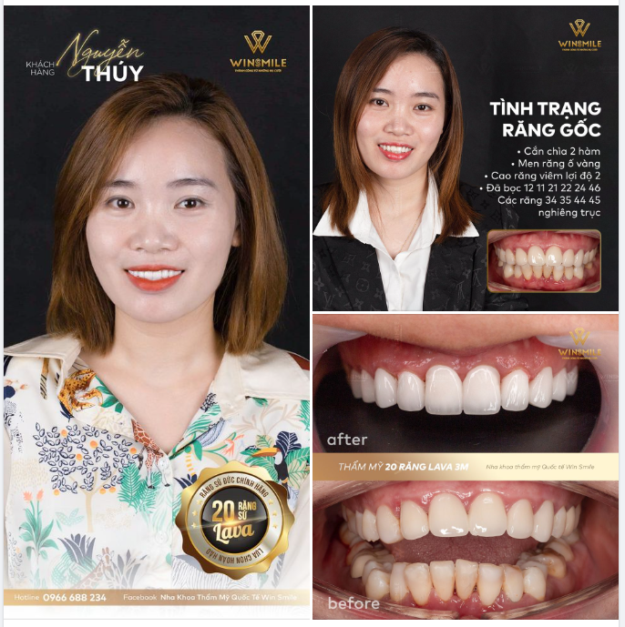 VĨNH BIỆT RĂNG Ố VÀNG, KHẤP KHỂNH CHỈ SAU 2 LẦN HẸN