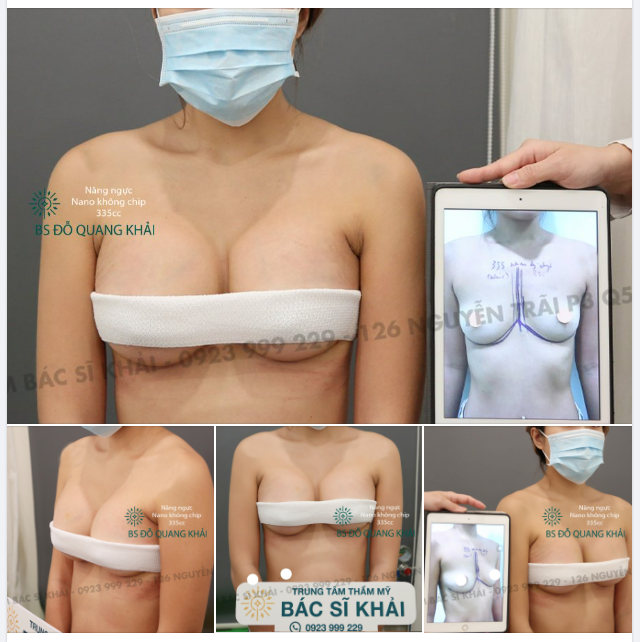 VÒNG 1 CỰC PHẨM CỦA KHÁCH HÀNG VỚI SIZE 335CC