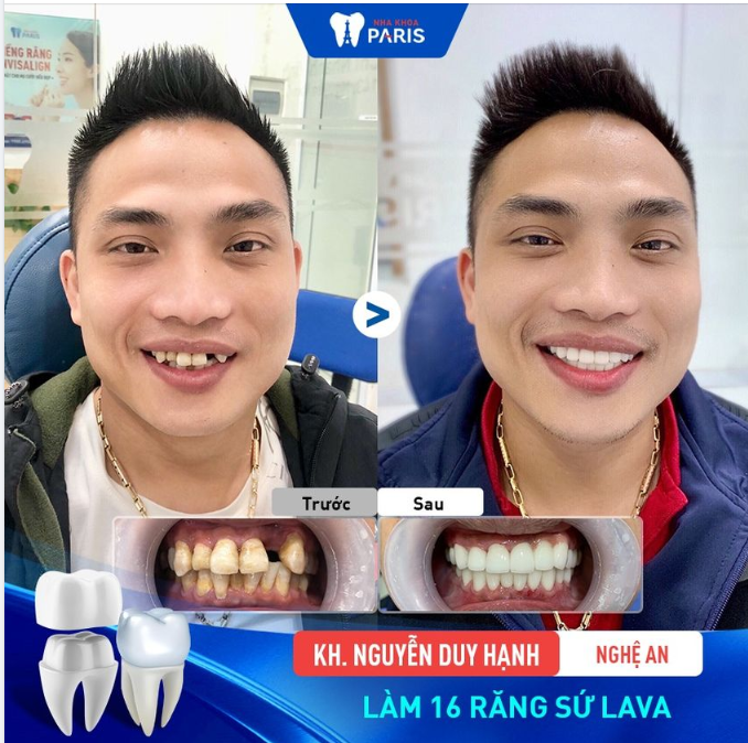VƯỢT NỬA VÒNG TRÁI ĐẤT ĐẾN NHA KHOA PARIS PHỤC HÌNH SỨ