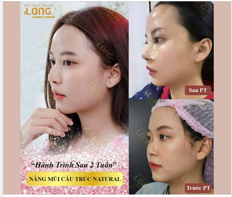 Xem ngay kết quả DÁNG MŨI SAU 7 NGÀY THỰC HIỆN