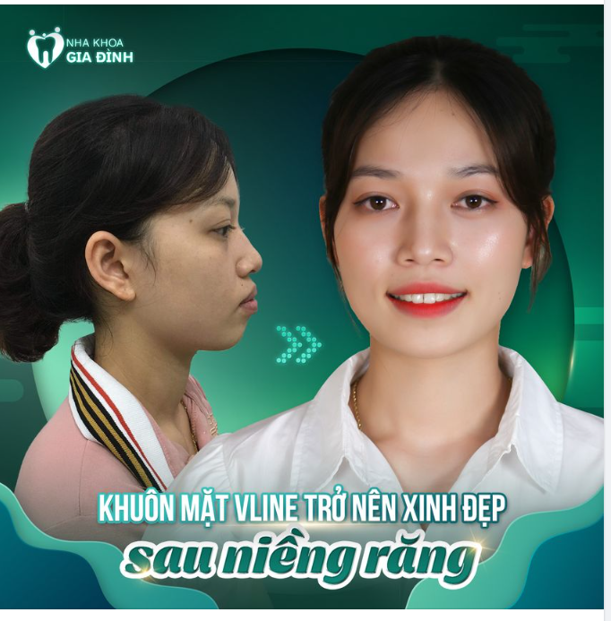 Xinh đẹp hơn sau khi niềng răng, thành quả mà ai cũng ao ước