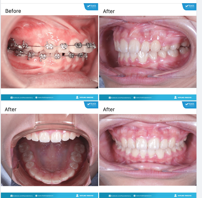 Xóa bỏ răng hô nhờ chỉnh nha- khôi phục tự tin vốn có