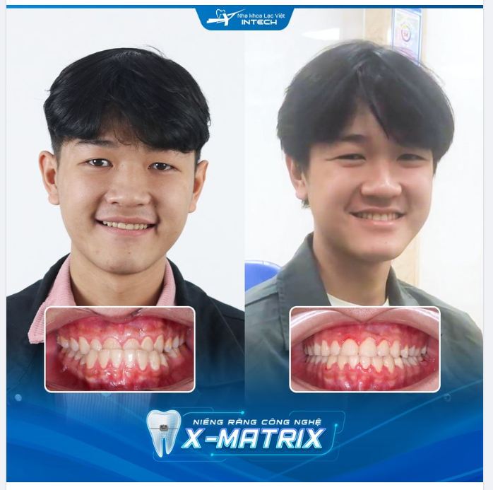 XÓA BỎ RĂNG MÓM - LỘT XÁC ĐỈNH CAO CÙNG NIỀNG RẮNG X-MATRIX