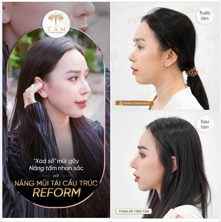 Xoá sổ mũi gãy - Nâng tầm nhan sắc