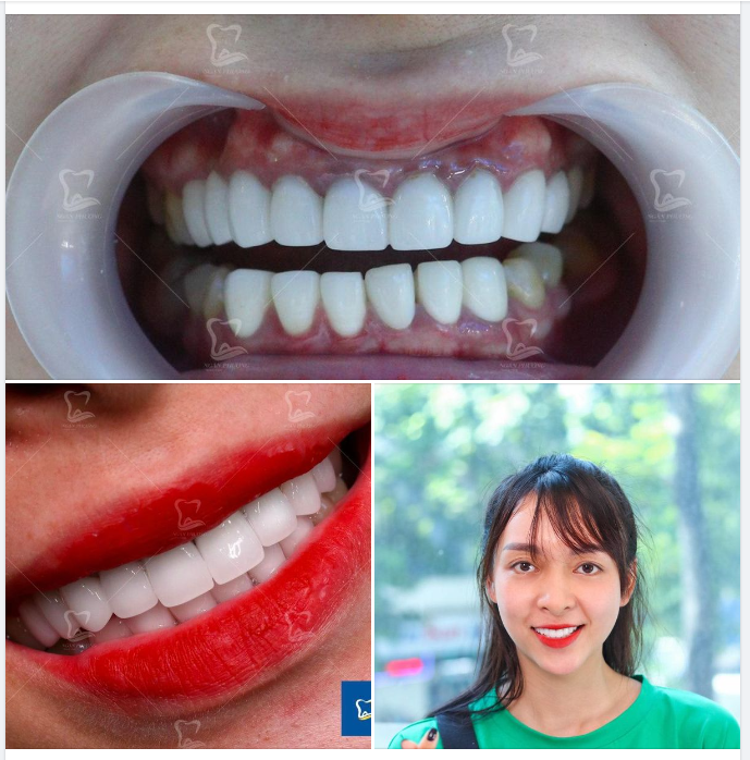 Xử lý "tổn thương", trả lại vẻ đẹp rạng ngời cho hàm răng